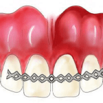 Safety Measures For Different Types Of Dental Trauma