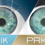 LASIK vs. PRK