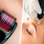 The Ultimate Guide to the Best Microneedle Roller for Radiant Skin