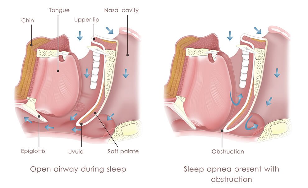 obstructive sleep apnea