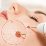mole removal London