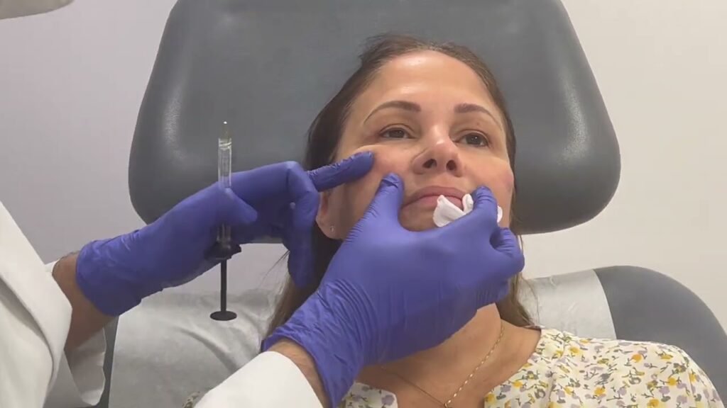 Cheek Fillers and Dysport in Miami